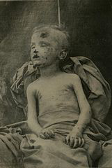 enfant_abuse