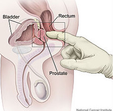 dessin_toucher_prostate