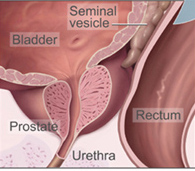 shema_prostate